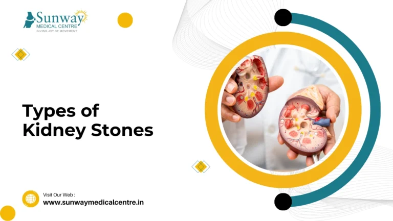 Types of Kidney Stones