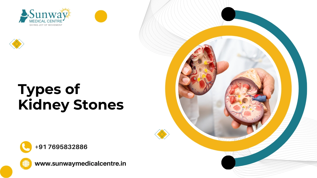 Types of Kidney Stones