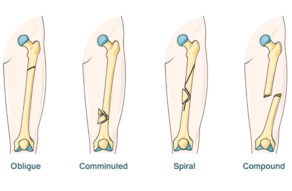 Orthopedic Trauma Care