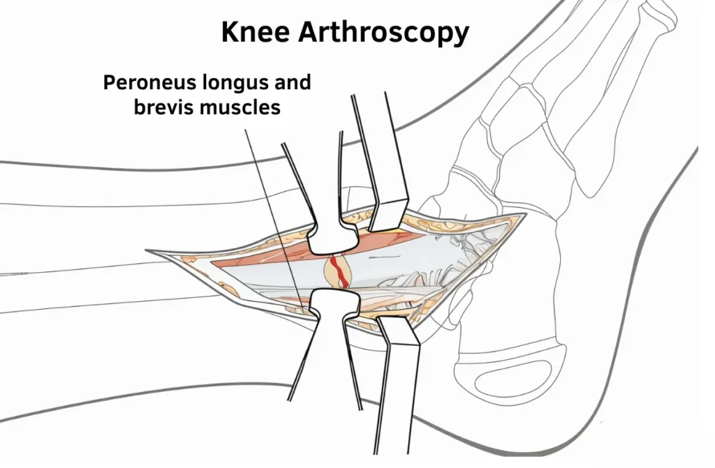 Knee Arthroscopy Recovery Time