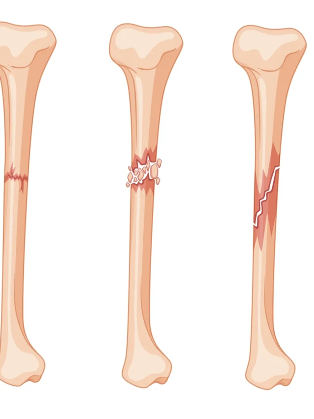 Various Types of Fractures